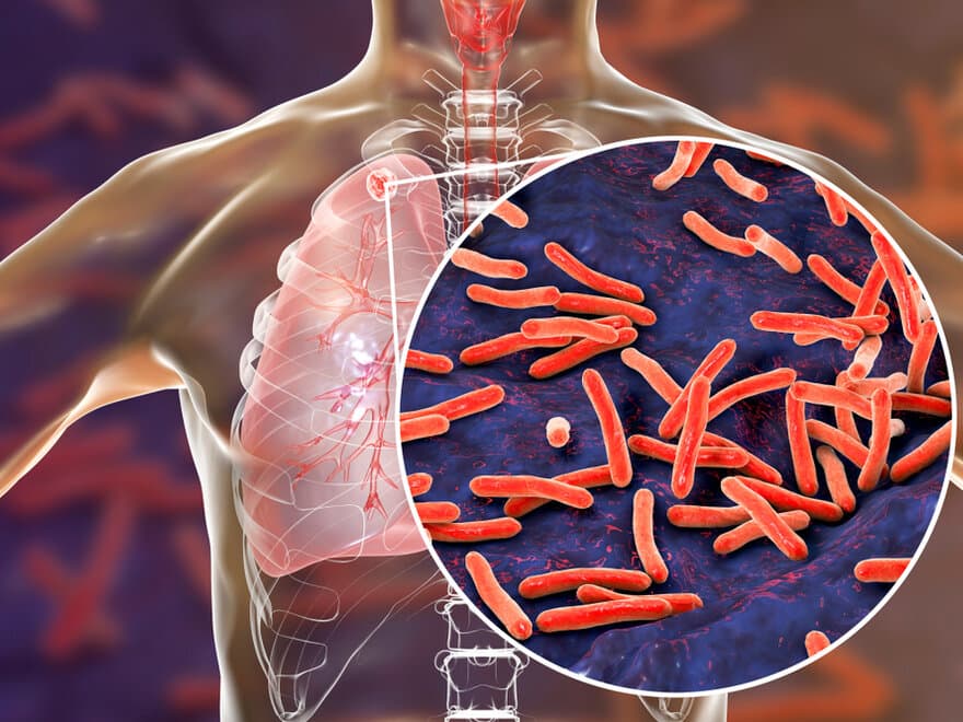 Secondary tuberculosis in lungs and close-up view of Mycobacterium tuberculosis bacteria, 3D illustration - Illustrasjon.